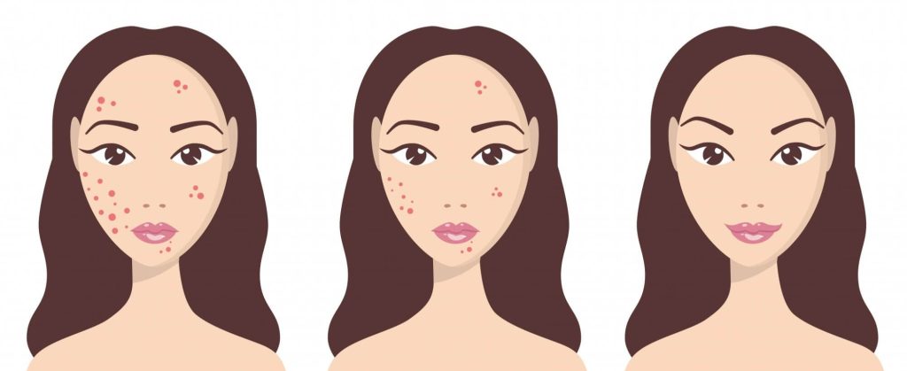 pimple treatment